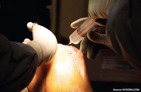 Periarticular-Injection-1024x444-with-copyright-1
