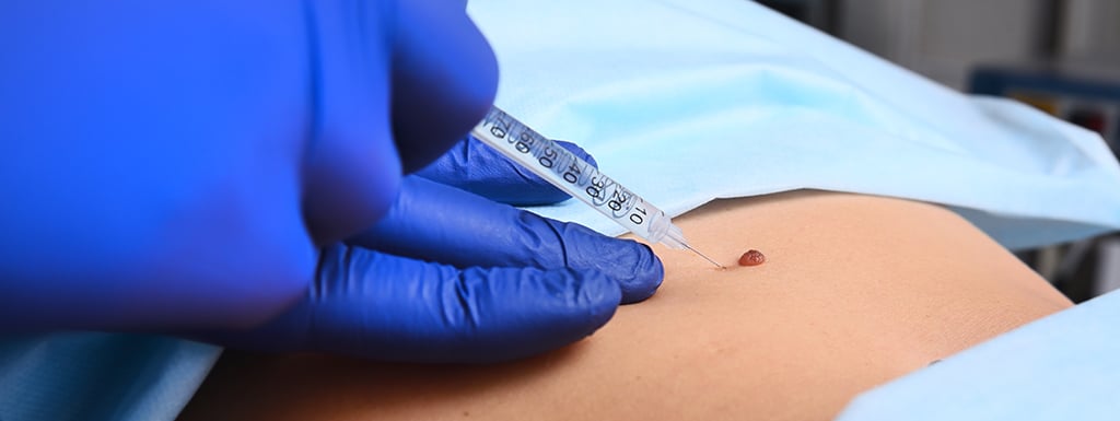 Mohs-Injection-Skin-Cancer-Mole-iStock-1297553950